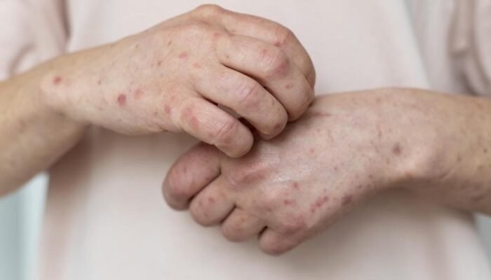 “Banten Tegang Karena Campak, Dinkes Diminta Amanat Stok Vaksin”